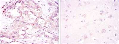 Immunohistochemistry: AMPK alpha 1 Antibody (2B7) - Azide and BSA Free [NBP2-80575] - Immunohistochemical analysis of paraffin-embedded ovarian cancer (left) and brain tissues (right) using AMPK alpha 1 mouse mAb with DAB staining. Image from the standard format of this antibody.