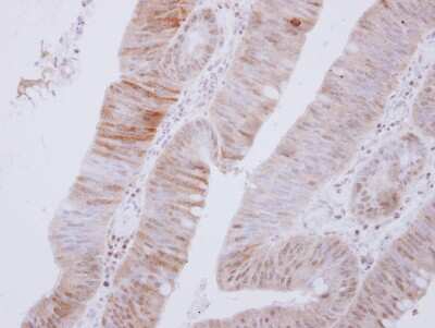 Immunohistochemistry-Paraffin: AMPK alpha 2 Antibody [NBP2-15381] - Paraffin-embedded Colon carcinoma, using antibody at 1:500 dilution.