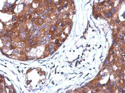 Immunohistochemistry-Paraffin: AMSH/STAMBP Antibody [NBP2-15383] - Paraffin-embedded Breast ca, using antibody at 1:500 dilution.