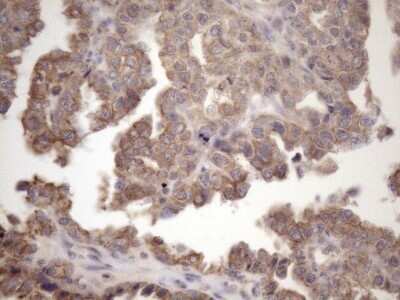 Immunohistochemistry: AMTN Antibody (OTI2D9) - Azide and BSA Free [NBP2-72507] - Analysis of Adenocarcinoma of Human ovary tissue. (Heat-induced epitope retrieval by 1mM EDTA in 10mM Tris buffer (pH8.5) at 120C for 3 min)