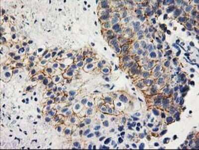 Immunohistochemistry-Paraffin: ANAPC2 Antibody (1A6) [NBP2-01128] - Staining of paraffin-embedded Carcinoma of Human bladder tissue using anti-ANAPC2 mouse monoclonal antibody.