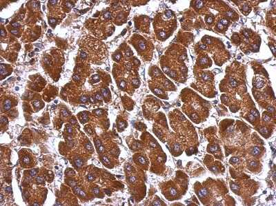 Immunohistochemistry-Paraffin: Angiopoietin-like Protein 3/ANGPTL3 Antibody [NBP2-15390] -  Human hepatoma, using ANGPTL3 antibody at 1:500 dilution. Antigen Retrieval: Trilogy™ (EDTA based, pH 8.0) buffer, 15min. 