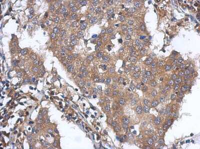 Immunohistochemistry-Paraffin: ANKLE2 Antibody [NBP2-15396] - Paraffin-embedded Breast ca, using antibody at 1:500 dilution.