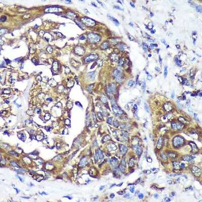 Immunohistochemistry-Paraffin: ANKLE2 Antibody [NBP2-92367] - Immunohistochemistry of paraffin-embedded Human lung cancer using ANKLE2 Rabbit pAb (NBP2-92367) at dilution of 1:100 (40x lens). Perform microwave antigen retrieval with 10 mM PBS buffer pH 7.2 before commencing with IHC staining protocol.