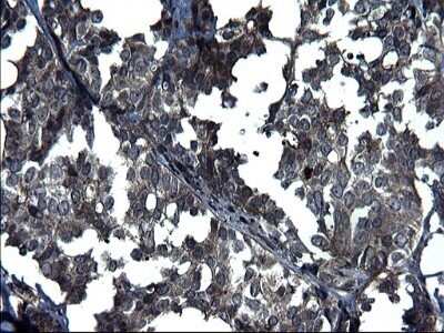 Immunohistochemistry: ANKMY2 Antibody (OTI1F11) - Azide and BSA Free [NBP2-72073] - Analysis of Adenocarcinoma of Human breast tissue. (Heat-induced epitope retrieval by 1 mM EDTA in 10mM Tris, pH8.5, 120C for 3min)