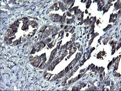 Immunohistochemistry: ANKMY2 Antibody (OTI1F11) - Azide and BSA Free [NBP2-72073] - Analysis of Adenocarcinoma of Human ovary tissue. (Heat-induced epitope retrieval by 1 mM EDTA in 10mM Tris, pH8.5, 120C for 3min)