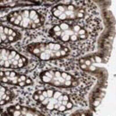 Immunohistochemistry: ANKRD11 Antibody [27880002] - Most of the normal cells showed strong nuclear positivity with an additional weaker cytoplasmic staining in many cases. Liver was weakly stained. Malignant cells displayed moderate to strong immunoreactivity.  Image and statement courtesy of the Human Protein Atlas (HPA).