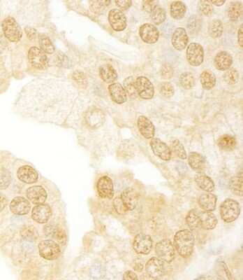 Immunohistochemistry-Paraffin: ANKRD17 Antibody [NB100-86996] - Human prostate carcinoma. Antibody used at a dilution of 1:1000 (1ug/ml).