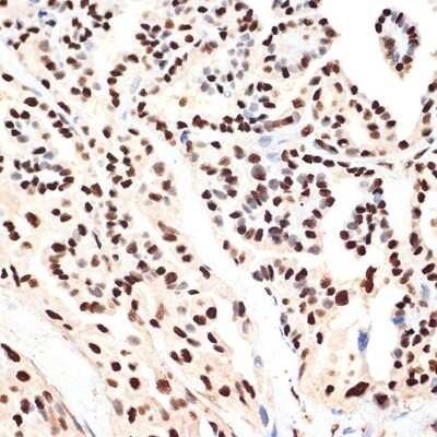 Immunohistochemistry-Paraffin: ANP32B Antibody (4A8E5) [NBP3-16199] - Immunohistochemistry of paraffin-embedded human thyroid cancer using ANP32B Rabbit mAb (NBP3-16199) at dilution of 1:100 (40x lens).Perform microwave antigen retrieval with 10 mM Tris/EDTA buffer pH 9.0 before commencing with IHC staining protocol.