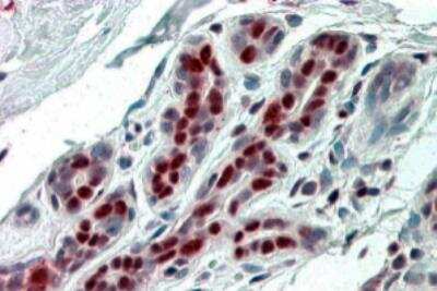 Immunohistochemistry-Paraffin: ANP32B Antibody [NB100-1199] - Staining of paraffin embedded Human Breast. Steamed antigen retrieval with citrate buffer pH 6, AP-staining.