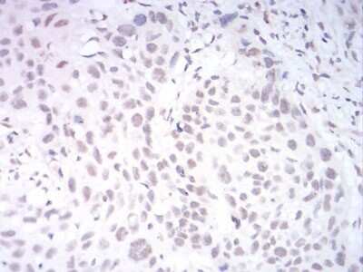 Immunohistochemistry: AOF1 Antibody (5E10C1) [NBP2-52415] - Analysis of paraffin-embedded esophageal cancer tissues using AOF1 mouse mAb with DAB staining.