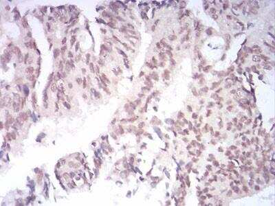 Immunohistochemistry: AOF1 Antibody (5E10C1) [NBP2-52415] - Analysis of paraffin-embedded rectum cancer tissues using AOF1 mouse mAb with DAB staining.