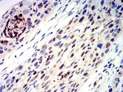 Immunohistochemistry: AP-2 gamma Antibody (3A11A5) [NBP2-61859] - Analysis of paraffin-embedded esophageal cancer tissues using TFAP2C mouse mAb with DAB staining.