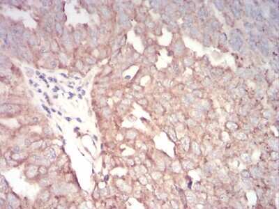 Immunohistochemistry-Paraffin: AP2 alpha Antibody (7D2B5) [NBP2-52572] - Analysis of paraffin-embedded ovarian cancer tissues using TFAP2A mouse mAb with DAB staining.