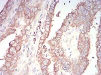 Immunohistochemistry-Paraffin: AP2 alpha Antibody (7D2B5) [NBP2-52572] - Analysis of paraffin-embedded TFAP2A tissues using endometrial cancer mouse mAb with DAB staining.