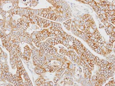 Immunohistochemistry-Paraffin: AP2M1 Antibody [NBP1-32272] - N87 xenograft, using AP2M1 antibody at 1:100 dilution. Antigen Retrieval: Trilogy™ (EDTA based, pH 8.0) buffer, 15min.