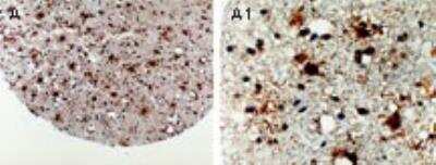 Immunohistochemistry-Paraffin: APAF-1 Antibody [NB100-56072] - Formalin-fixed, paraffin-embedded tissue core of human glioma (grade II) stained for Apaf-1 espression using this antibody at 1:2000. A and A1. Low and high magnification, respectively Hematoxylin-eosin counterstain.