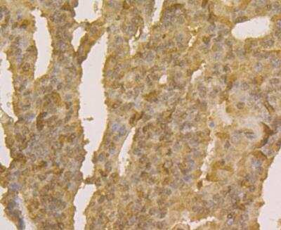 Immunohistochemistry: APE Antibody (12H1) [NBP2-76919] - Immunohistochemical analysis of paraffin-embedded human prostate cancer tissue using anti-APE1 antibody. The section was pre-treated using heat mediated antigen retrieval with sodium citrate buffer (pH 6.0) for 20 minutes. The tissues were blocked in 5% BSA for 30 minutes at room temperature, washed with ddH2O and PBS, and then probed with the antibody at 1/200 dilution, for 30 minutes at room temperature and detected using an HRP conjugated compact polymer system. DAB was used as the chrogen. Counter stained with hematoxylin and mounted with DPX.