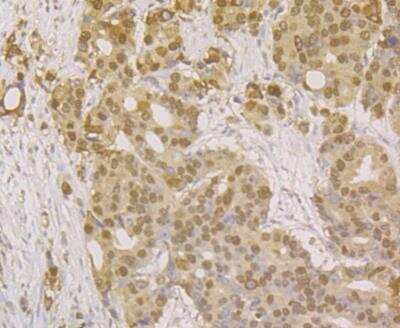Immunohistochemistry: APE Antibody (12H4) [NBP2-76930] - Immunohistochemical analysis of paraffin-embedded human prostate cancer tissue using anti-APE1 antibody. The section was pre-treated using heat mediated antigen retrieval with sodium citrate buffer (pH 6.0) for 20 minutes. The tissues were blocked in 5% BSA for 30 minutes at room temperature, washed with ddH2O and PBS, and then probed with the antibody at 1/200 dilution, for 30 minutes at room temperature and detected using an HRP conjugated compact polymer system. DAB was used as the chrogen. Counter stained with hematoxylin and mounted with DPX.