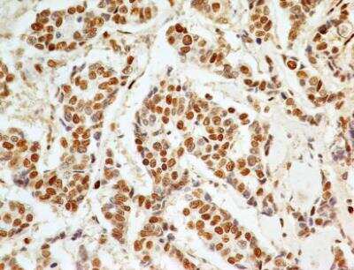 Immunohistochemistry-Paraffin: APIP Antibody (19F461) - Azide Free [NBP2-33231] - Formalin-fixed, paraffin-embedded adenocarcinoma of the breast stained with APIP antibody (5 ug/ml), peroxidase-conjugate and DAB chromogen. Staining of formalin-fixed tissues is enhanced by boiling tissue sections in 10 mM sodium citrate buffer, pH 6.0 for 10-20 min followed by cooling at RT for 20 min.
