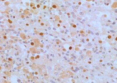 Immunohistochemistry-Paraffin: APIP Antibody (19F461) - Azide Free [NBP2-33231] -  Analysis of human renal cancer tissue section using APIP antibody (clone 19F461) at a concentration of 5 ug/ml. The representative image shows a nuclear and cytoplasmic staining pattern of APIP expression in cancer cells.
