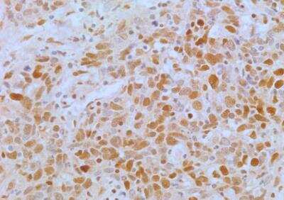 Immunohistochemistry-Paraffin: APIP Antibody (19F461) - Azide Free [NBP2-33231] - Analysis of human lung cancer tissue section using APIP antibody (clone 19F461) at a concentration of 5 ug/ml. The representative image shows a nuclear and cytoplasmic staining pattern of APIP expression in lung cancer cells.