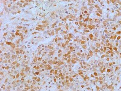 Immunohistochemistry-Paraffin: APIP Antibody (19F461) [NB100-56567] - Analysis of human lung cancer tissue section using APIP antibody (clone 19F461) at a concentration of 5 ug/ml. The representative image shows a nuclear and cytoplasmic staining pattern of APIP expression in lung cancer cells.
