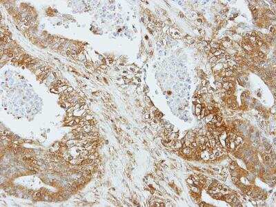 Immunohistochemistry-Paraffin: APJ/Apelin receptor Antibody [NBP1-30869] - Paraffin-embedded OVCA xenograft, using antibody at 1:100 dilution.