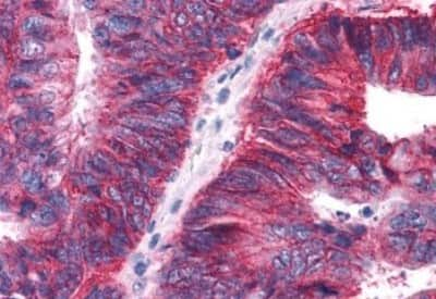 Immunohistochemistry-Paraffin: APJ/Apelin receptor Antibody [NBP3-14541] - Immunohistochemistry of formalin-fixed, paraffin-embedded human colon carcimona after heat-induced antigen retrieval.