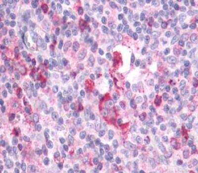 Immunohistochemistry-Paraffin: APJ/Apelin receptor Antibody [NLS63] - Lymph node, Hodgkin's lymphoma