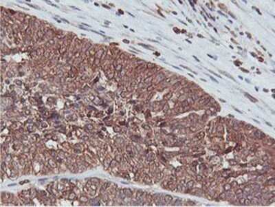 Immunohistochemistry: APMAP Antibody (OTI4F6) - Azide and BSA Free [NBP2-72080] - Staining of paraffin-embedded Adenocarcinoma of Human ovary tissue using anti-APMAP mouse monoclonal antibody.