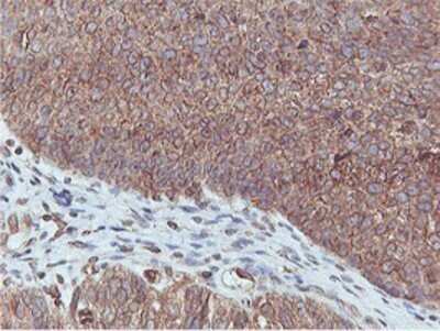 Immunohistochemistry: APMAP Antibody (OTI4F6) - Azide and BSA Free [NBP2-72080] - Staining of paraffin-embedded Carcinoma of Human bladder tissue using anti-APMAP mouse monoclonal antibody.