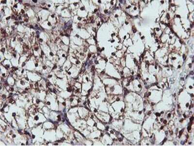 Immunohistochemistry: APMAP Antibody (OTI4F6) - Azide and BSA Free [NBP2-72080] - Staining of paraffin-embedded Carcinoma of Human kidney tissue using anti-APMAP mouse monoclonal antibody.