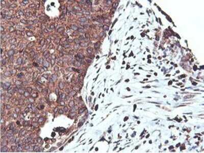 Immunohistochemistry: APMAP Antibody (OTI4F6) - Azide and BSA Free [NBP2-72080] - Staining of paraffin-embedded Carcinoma of Human lung tissue using anti-APMAP mouse monoclonal antibody.