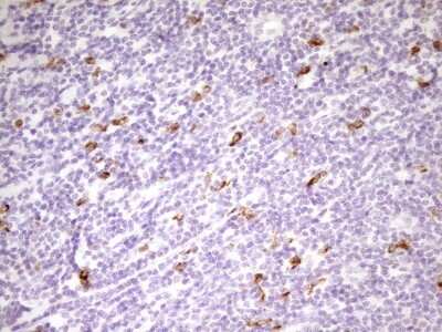 Immunohistochemistry: APOB48R Antibody (OTI1B1) [NBP2-46532] -  Analysis of Carcinoma of Human prostate tissue. (Heat-induced epitope retrieval by 1 mM EDTA in 10mM Tris, pH8.5, 120C for 3min)