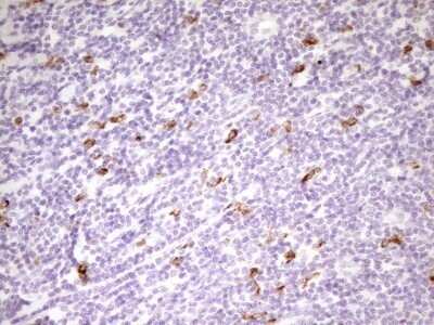 Immunohistochemistry: APOB48R Antibody (OTI1B1) - Azide and BSA Free [NBP2-72052] - Analysis of Carcinoma of Human prostate tissue. (Heat-induced epitope retrieval by 1 mM EDTA in 10mM Tris, pH8.5, 120C for 3min)