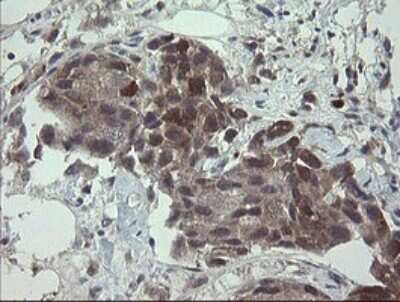 Immunohistochemistry: APP Antibody (OTI4C9) - Azide and BSA Free [NBP2-70197] - Analysis of Adenocarcinoma of Human breast tissue.