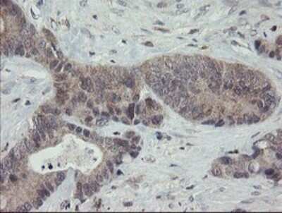 Immunohistochemistry: APP Antibody (OTI4C9) - Azide and BSA Free [NBP2-70197] - Analysis of Adenocarcinoma of Human colon tissue.