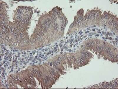 Immunohistochemistry: APP Antibody (OTI4C9) - Azide and BSA Free [NBP2-70197] - Analysis of Adenocarcinoma of Human endometrium tissue.