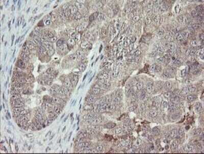 Immunohistochemistry: APP Antibody (OTI4C9) - Azide and BSA Free [NBP2-70197] - Analysis of Adenocarcinoma of Human ovary tissue.