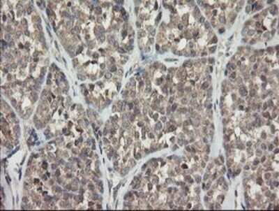 Immunohistochemistry: APP Antibody (OTI4C9) - Azide and BSA Free [NBP2-70197] - Analysis of Carcinoma of Human thyroid tissue.