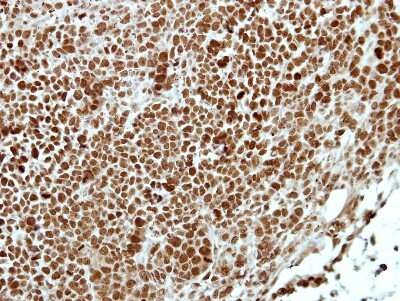 Immunohistochemistry-Paraffin: APPL Antibody [NBP2-15434] -  AZ521 xenograft, using APPL1 antibody at 1:100 dilution.  Antigen Retrieval: Trilogy™ (EDTA based, pH 8.0) buffer, 15min. 