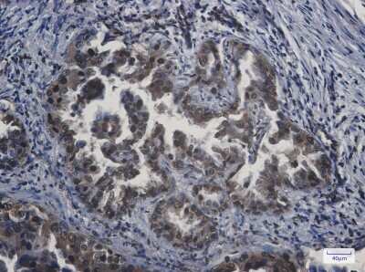 Immunohistochemistry-Paraffin: APPL Antibody (S05-8D5) [NBP3-14998] - Immunohistochemistry of APPL in paraffin-embedded Human lung cancer tissue using APPL Rabbit mAb at dilution 1/20