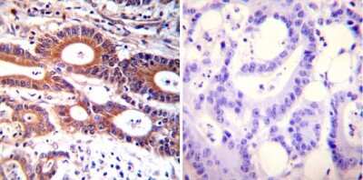 Immunohistochemistry-Paraffin: ARF1 Antibody (1D9) [NB300-505] - Both normal and cancer biopsies of deparaffinized Human colon carcinoma tissues.