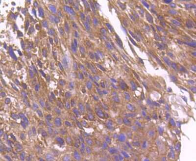 Immunohistochemistry-Paraffin: ARF1 Antibody (SD2002) [NBP2-67739] - Analysis of paraffin-embedded human breast carcinoma tissue using anti-ARF1 antibody. Counter stained with hematoxylin.