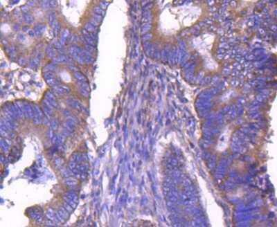 Immunohistochemistry-Paraffin: ARF1 Antibody (SD2002) [NBP2-67739] - Analysis of paraffin-embedded human colon cancer tissue using anti-ARF1 antibody. Counter stained with hematoxylin.