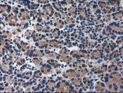 Immunohistochemistry-Paraffin: ARFGAP1 Antibody (1F6) [NBP2-00513] - Staining of paraffin-embedded Carcinoma of Human thyroid tissue using anti-ARFGAP1 mouse monoclonal antibody.