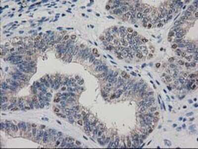 Immunohistochemistry: ARFGAP1 Antibody (OTI1F6) - Azide and BSA Free [NBP2-72013] - Staining of paraffin-embedded Adenocarcinoma of Human endometrium tissue using anti-ARFGAP1 mouse monoclonal antibody.