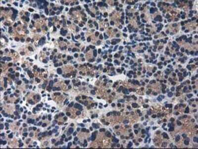 Immunohistochemistry: ARFGAP1 Antibody (OTI1F6) - Azide and BSA Free [NBP2-72013] - Staining of paraffin-embedded Carcinoma of Human thyroid tissue using anti-ARFGAP1 mouse monoclonal antibody.
