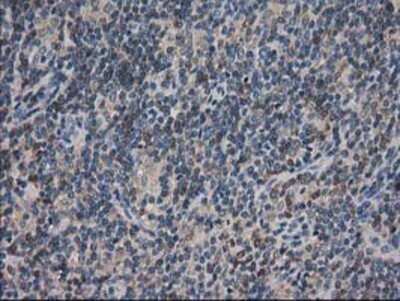 Immunohistochemistry: ARFGAP1 Antibody (OTI1F6) - Azide and BSA Free [NBP2-72013] - Staining of paraffin-embedded Human lymphoma tissue using anti-ARFGAP1 mouse monoclonal antibody.